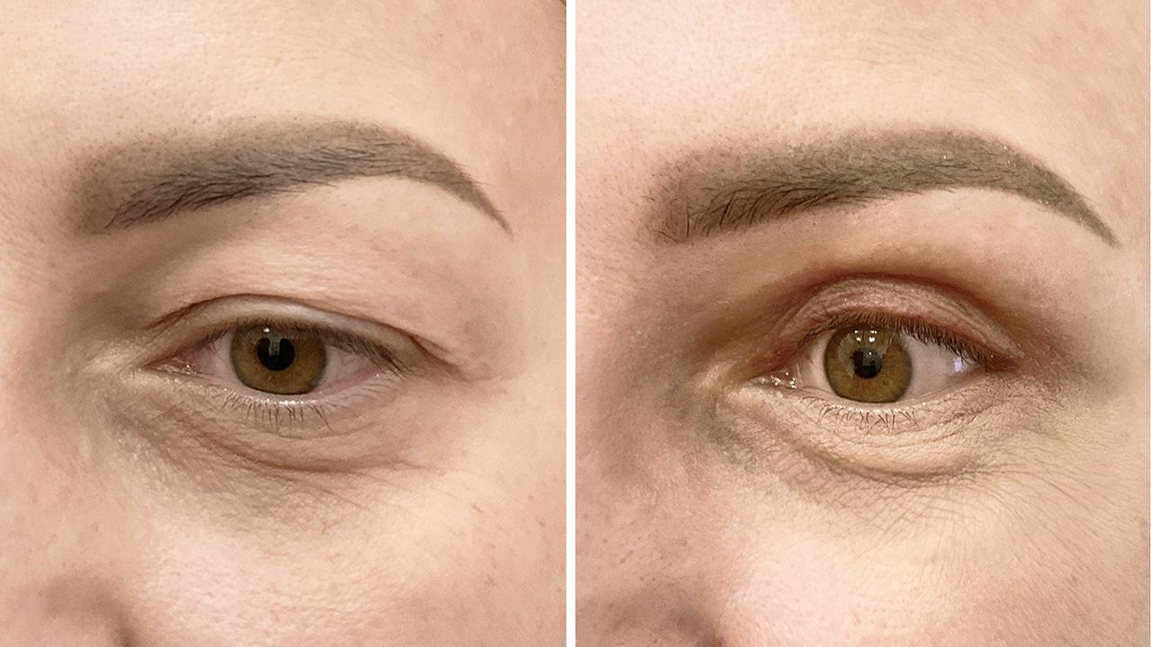 Kobiece oczy przed i po blefaroplastyce