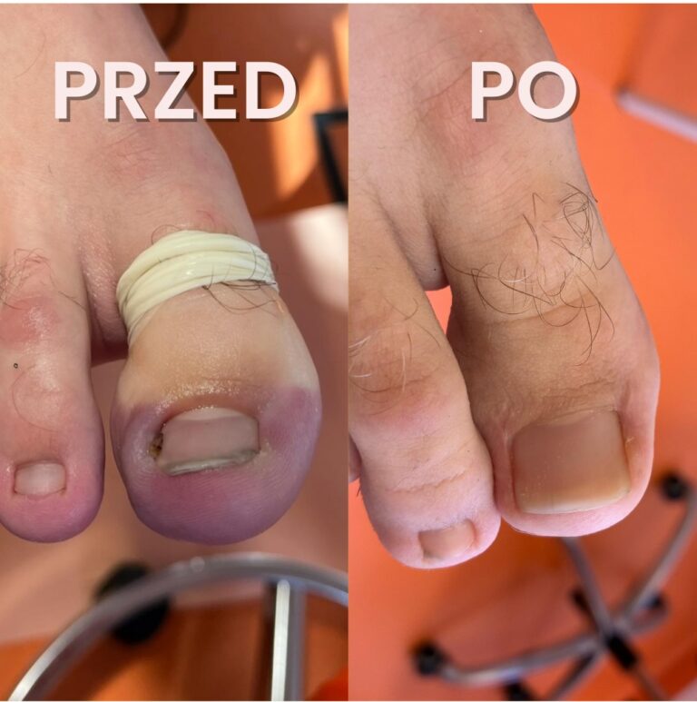 Plastyka wałów paznokciowych przed i po